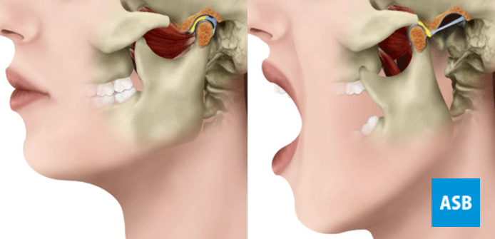 D.T.M. (Disfunção da Articulação Temporomandibular)