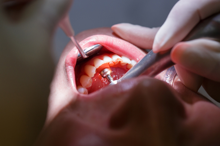 O ASB pode fazer profilaxia dental nos pacientes?