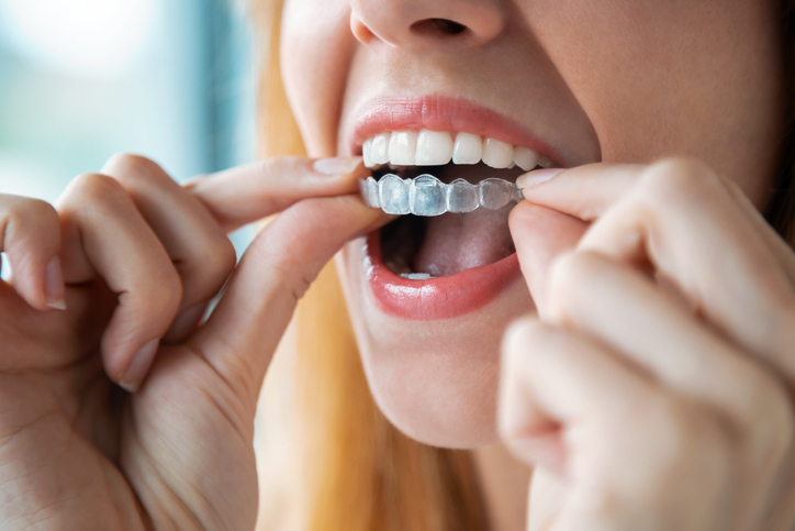 O que devo saber antes do clareamento dental?