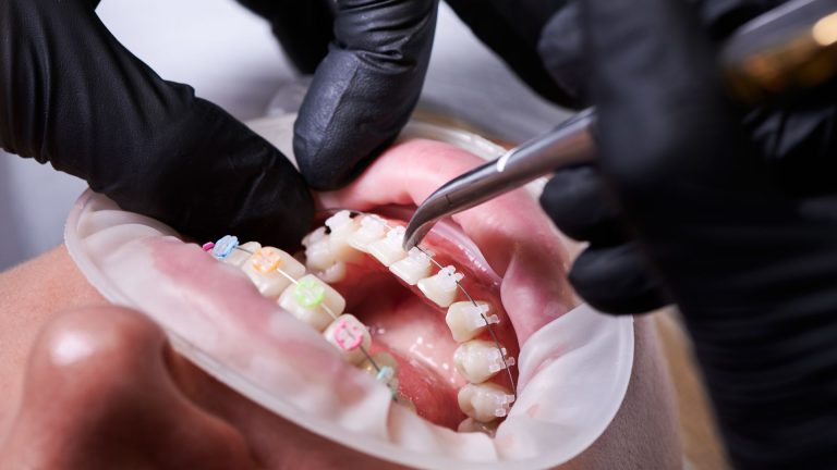 Implante dentário: 3 cuidados importantes após colocá-lo