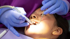 Gengiva retraída: tudo o que você precisa saber